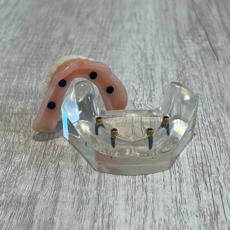 snap-in implant dentures Rochester Hills, MI