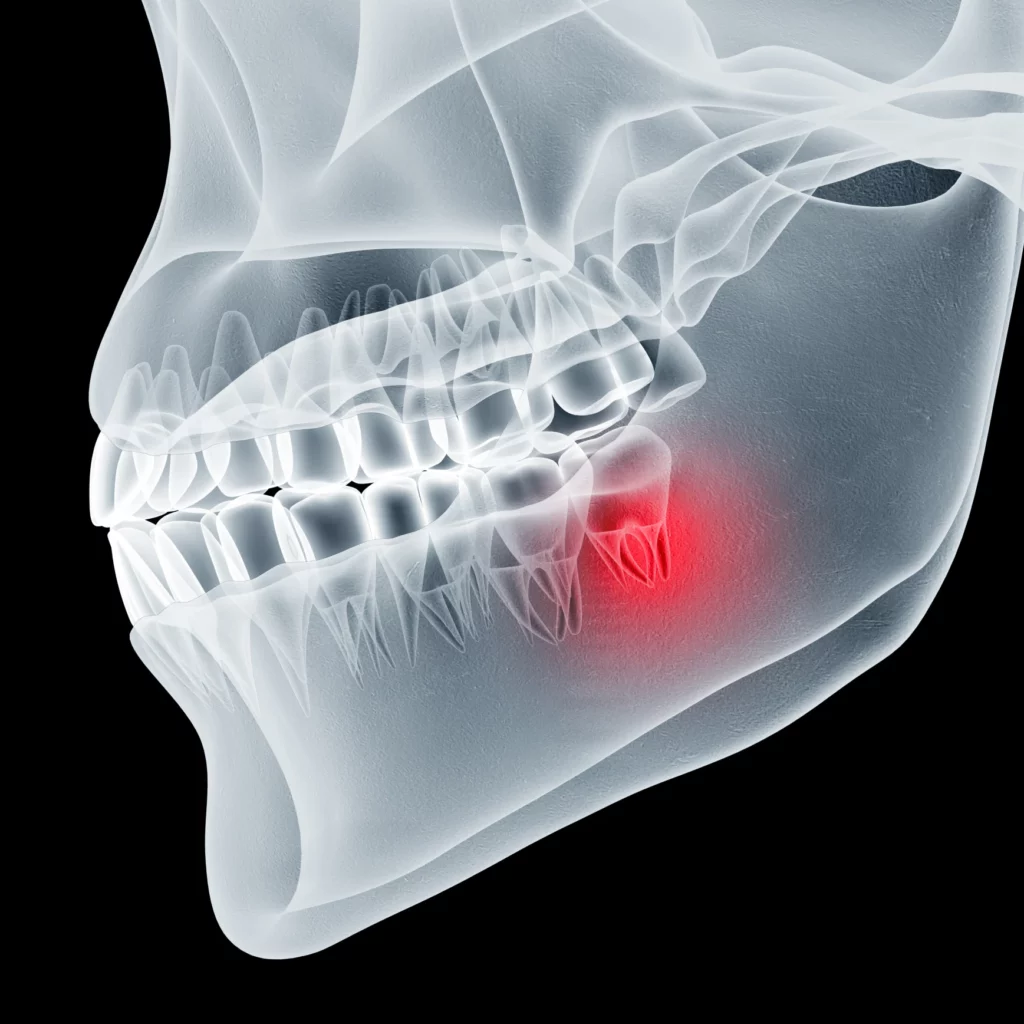 wisdom teeth removal in Rochester Hills, MI